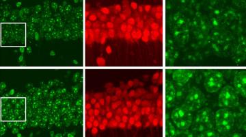 In this figure, neurons in the bottom row, which are missing the HDAC1 gene, show higher levels of DNA damage (green) than normal neurons.Image courtesy of the researchers