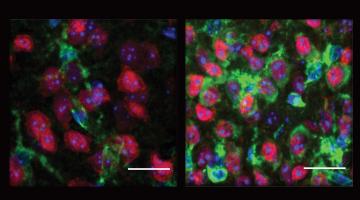 MIT neuroscientists have linked the vulnerability of neurons in Hungtington's disease to the release of mitochondrial RNA and an associated immune system response. In this image, on the right are neurons from a Huntington's model mouse showing muc...